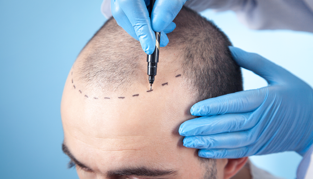 FUE vs. FUT: How Technique Affects Hair Transplant Cost
